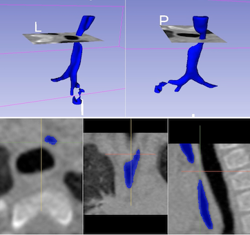 Tracheomalacia modeling